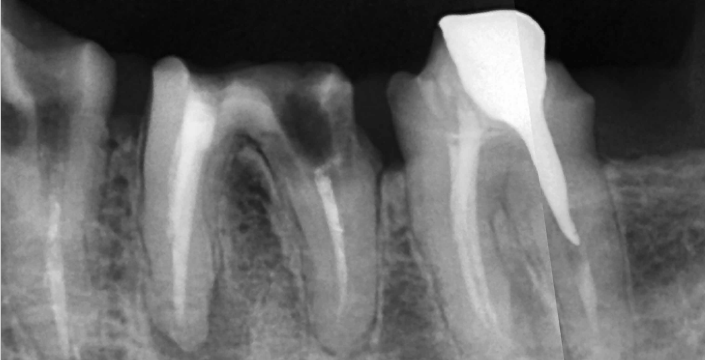 A condição radiográfica evidencia boa indicação dos septos ósseos e quantidade de osso apicalmente às raízes, suficientes para o planejamento de implantes imediatos.