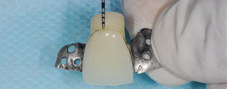 Use uma sonda periodontal milimetrada: deve haver 3 mm de profundidade do pôntico até à linha gengival.
