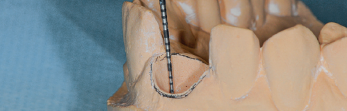 Detalhe da sonda periodontal milimetrada na região proximal programando a reconstrução alveolar.