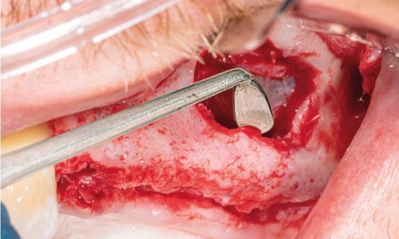 Com a antrostomia concluída, a membrana sinusal é descolada do assoalho para aumento no seio maxilar sobre os locais planejados para os implantes.