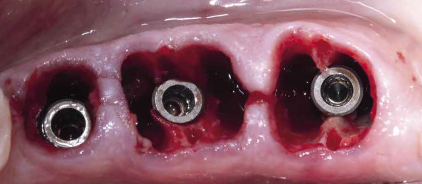 Implantes cone morse (Implacil Due Cone 4 x 9) instalados com boa estabilidade primária (30Ncm).