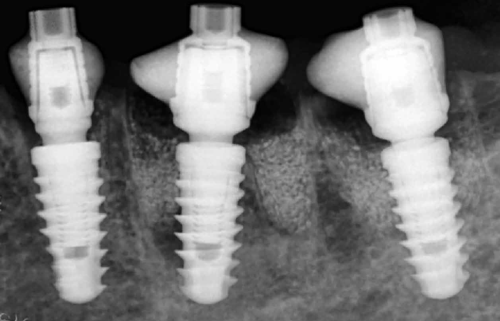 Na radiografia periapical, pode-se ver o biomaterial e a anatomia do cicatrizador mantendo os contornos dos tecidos moles peri-implantares.