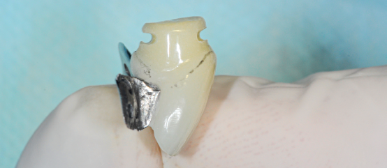 Além disso, use uma broca esférica 0,8-0.9 mm para escavar uma canaleta por vestibular e palatino ao nível médio da marcação da margem gengival e a porção mais apical do pôntico.