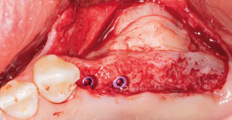 Dobre a extremidade da primeira membrana sobre a porção vestibular do enxerto. Coloque outra membrana de FRP sobre a antrostomia lateral. Os dois implantes na área dos pré-molares não necessitam de elevação do seio maxilar. O levantamento do seio foi realizado em etapas, com os implantes planejados nos locais dos molares após a cicatrização.