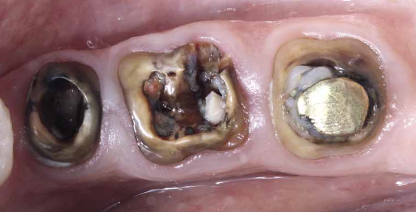 Raízes com indicação de exodontia. Observe a boa condição gengival e o bom posicionamento protético dos remanescentes, com espaço protético interoclusal preservado e indicação de implante imediatos com preservação alveolar.