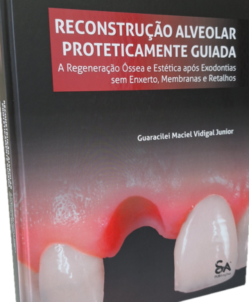 Reconstrução Alveolar Proteticamente Guiada, de Guaracilei Maciel Vidigal Junior.