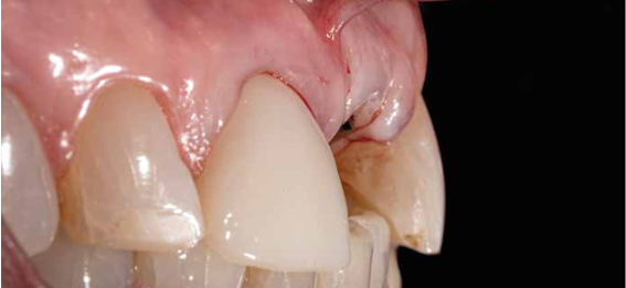 Deficiência de tecido mole compensada pela cirurgia