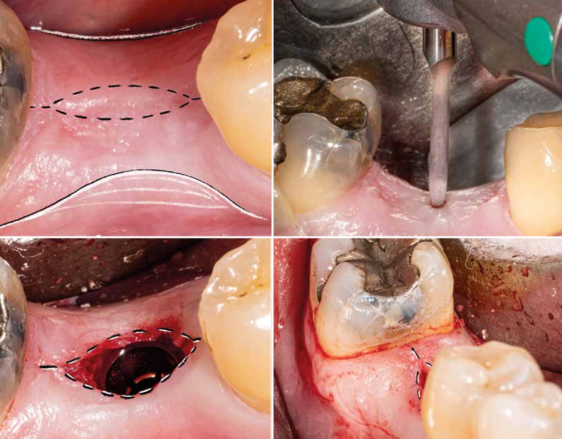 Um ligeiro aumento na largura da crista seria ideal neste caso, portanto, uma incisão elíptica é planejada compensando a deficiência de tecido mole.