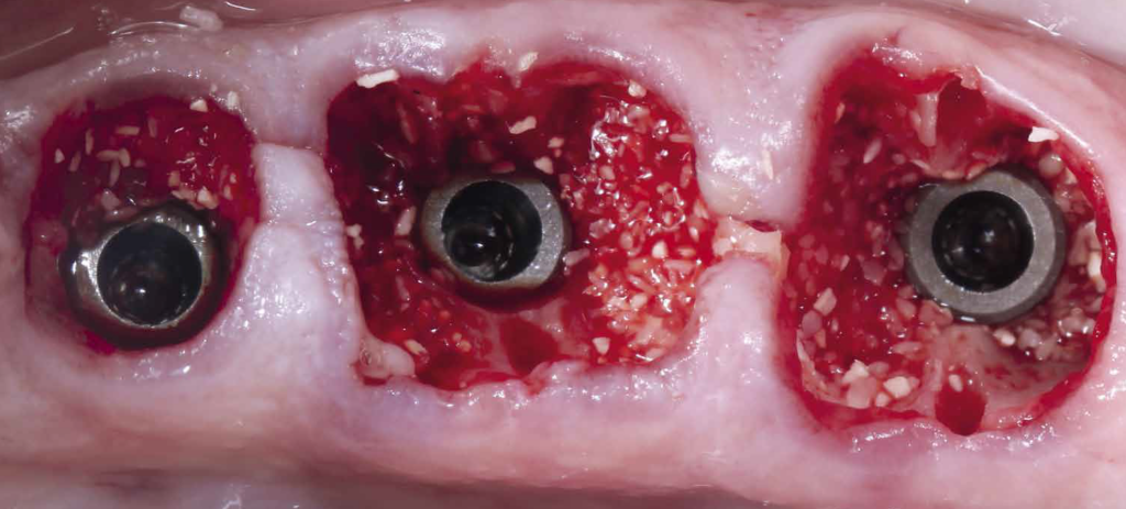 Preenchimento dos gaps com biomaterial à base de Hidroxiapatita com colágeno (ExtraGraft). Uma ajuda na preservação alveolar.