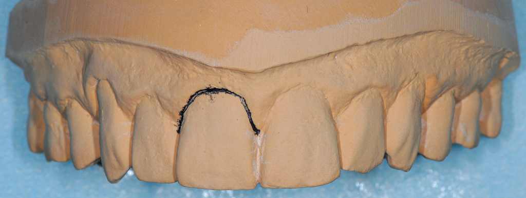 Reconstrução alveolar proteticamente guiada: comece marcando a linha gengival no modelo de gesso com um lápis preto.