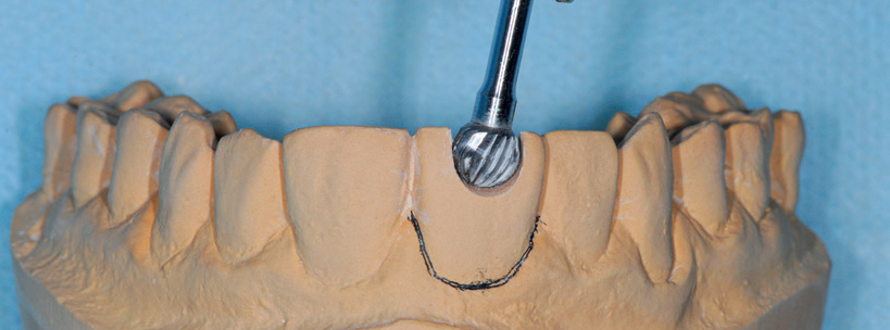 Em seguida, use uma broca esférica com diâmetro 5mm para remover apenas a coroa dentária.
