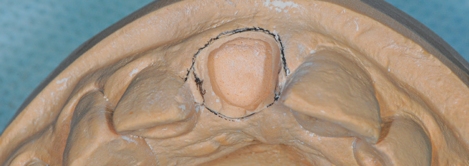 O uso da broca esférica 2 mm cria um nicho 1mm aquém da linha do lápis preto.