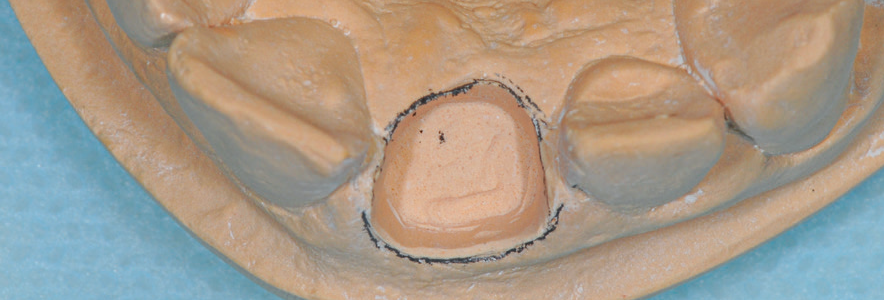 Depois, as paredes laterais do nicho são trabalhadas com uma broca tronco cônica reta. Assim, as paredes do gesso imitam o formato da raiz do incisivo central superior.