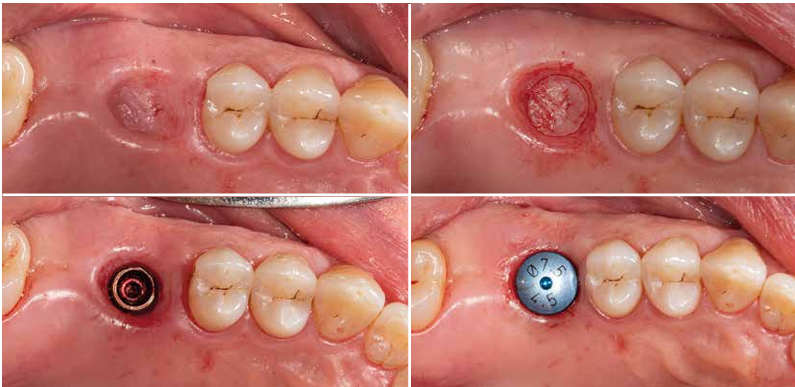 Uma incisão circular por punch no tecido funciona bem. Não há deficiência de tecido mole. Neste caso, o centro do implante foi marcado com a broca inicial sob navegação dinâmica.