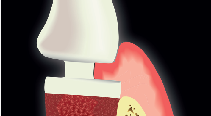 reconstrucao alveolar proteticamente guiada